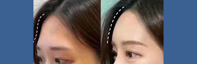 Fat transfer to the fore head Patient 01